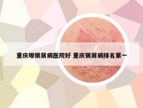 重庆哪银屑病医院好 重庆银屑病排名第一