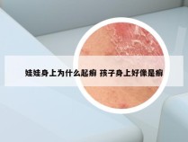 娃娃身上为什么起癣 孩子身上好像是癣