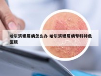 哈尔滨银屑病怎么办 哈尔滨银屑病专科特色医院