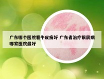 广东哪个医院看牛皮癣好 广东省治疗银屑病哪家医院最好