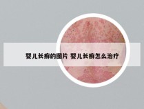 婴儿长癣的图片 婴儿长癣怎么治疗