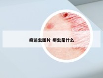 癣达虫图片 癣虫是什么