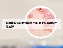 百度离心性后天性白班什么 离心性白斑能不能治好