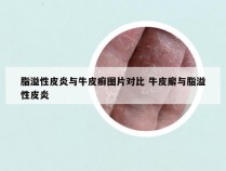 脂溢性皮炎与牛皮癣图片对比 牛皮廨与脂溢性皮炎