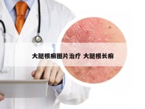 大腿根癣图片治疗 大腿根长癣