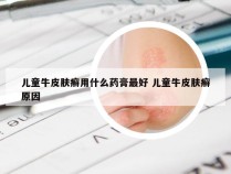 儿童牛皮肤癣用什么药膏最好 儿童牛皮肤癣原因