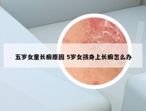 五岁女童长癣原因 5岁女孩身上长癣怎么办