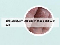 刚开始起癣扣了以后变红了 起癣之后变白怎么办