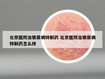 北京医院治银屑病特制药 北京医院治银屑病特制药怎么样