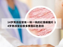 14岁男孩后背有一块一块的红像癣图片 14岁男孩背后很多横像红色条纹