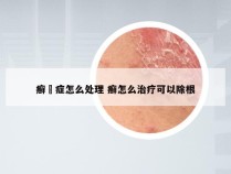 癣蔴症怎么处理 癣怎么治疗可以除根