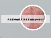 类银屑病有偏方 治银屑病偏方有哪些?