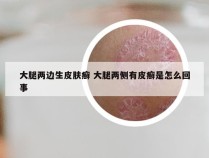 大腿两边生皮肤癣 大腿两侧有皮癣是怎么回事