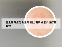 腿上有白点怎么治疗 腿上有白点怎么治疗最有效