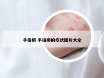 手指癣 手指癣的症状图片大全