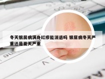 冬天银屑病满身红疹能消退吗 银屑病冬天严重还是夏天严重