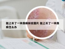 腿上长了一块像癣掉皮图片 腿上长了一块像癣怎么办