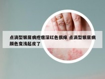 点滴型银屑病疙瘩深红色很痒 点滴型银屑病颜色变浅起皮了