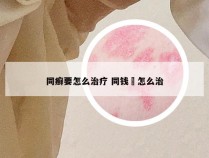 同癣要怎么治疗 同钱廯怎么治