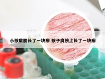 小孩肩膀长了一块癣 孩子肩膀上长了一块癣