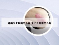 老婆头上长癣怎么弄 头上长癣该怎么办