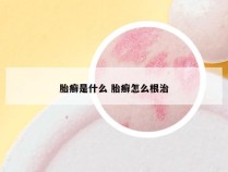 胎癣是什么 胎癣怎么根治