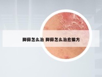 脚藓怎么治 脚藓怎么治愈偏方