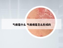 气癣是什么 气瘿病是怎么形成的