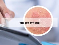 银屑病式关节疼痛