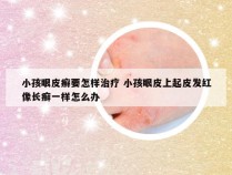 小孩眼皮癣要怎样治疗 小孩眼皮上起皮发红像长癣一样怎么办