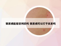 银屑病能输甘利欣吗 银屑病可以打干扰素吗