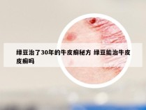 绿豆治了30年的牛皮癣秘方 绿豆能治牛皮皮癣吗