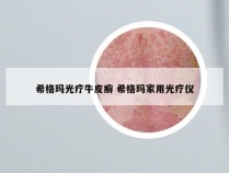 希格玛光疗牛皮癣 希格玛家用光疗仪