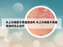 头上长癣属于真菌感染吗 头上长癣属于真菌感染吗怎么治疗