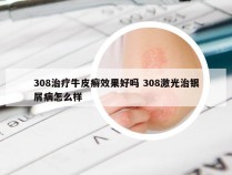 308治疗牛皮癣效果好吗 308激光治银屑病怎么样