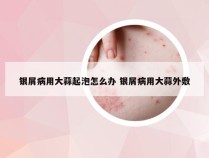 银屑病用大蒜起泡怎么办 银屑病用大蒜外敷