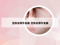 怎样会得牛皮癣 怎样会得牛皮廨