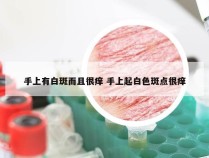 手上有白斑而且很痒 手上起白色斑点很痒