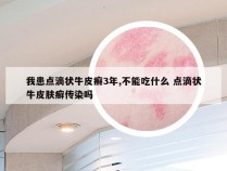 我患点滴状牛皮癣3年,不能吃什么 点滴状牛皮肤癣传染吗