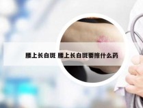 腰上长白斑 腰上长白斑要擦什么药