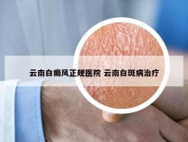 云南白癜风正规医院 云南白斑病治疗