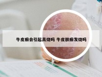 牛皮癣会引起高烧吗 牛皮肤癣发烧吗