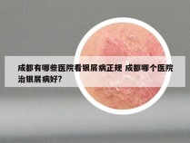 成都有哪些医院看银屑病正规 成都哪个医院治银屑病好?