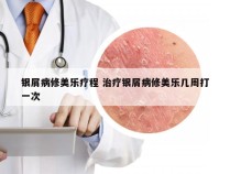 银屑病修美乐疗程 治疗银屑病修美乐几周打一次