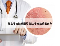 腿上牛皮肤癣图片 腿上牛皮肤癣怎么办