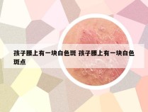 孩子腰上有一块白色斑 孩子腰上有一块白色斑点