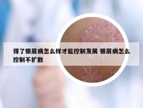 得了银屑病怎么样才能控制发展 银屑病怎么控制不扩散