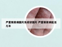 严重银屑病图片及症状图片 严重银屑病能活几年