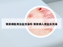 银屑病能用浴盐洗澡吗 银屑病人用盐水洗澡