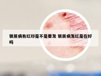 银屑病有红印是不是要发 银屑病发红是在好吗